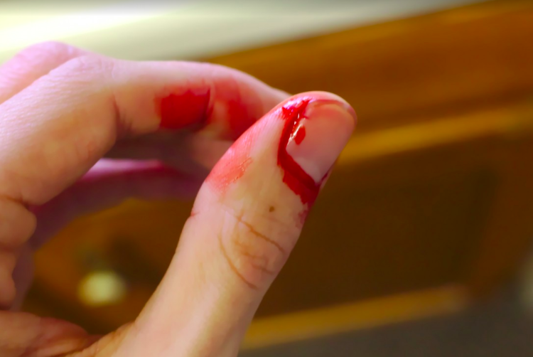 How to stop bleeding fingertip cut off home remedies