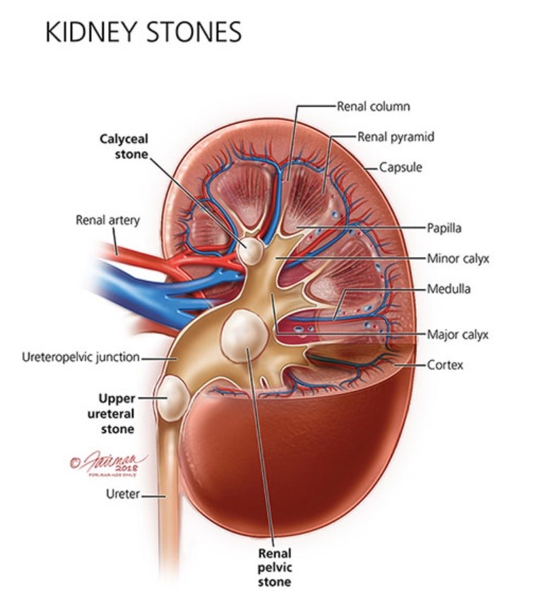 Kidney Stone in Human Body